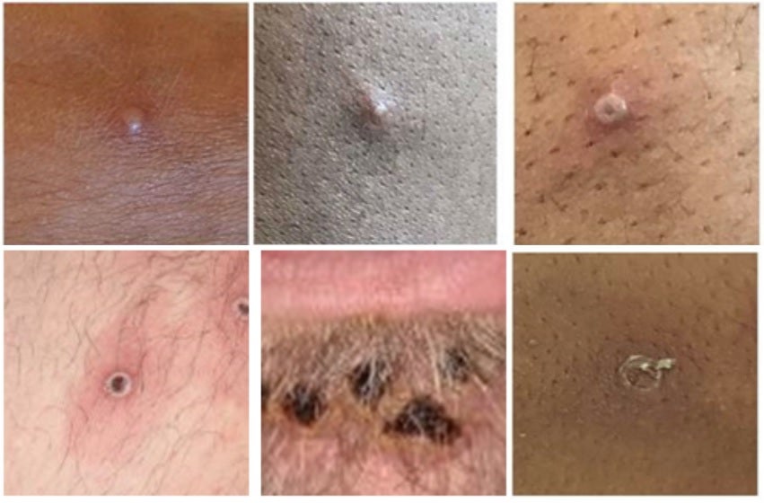 Lesiones de Mpox en la piel. 